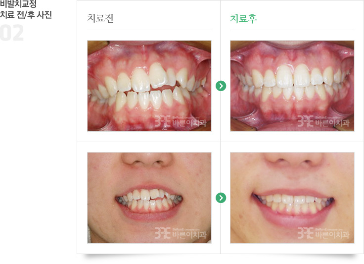 비발치교정 치료 전/후 사진 이미지 02