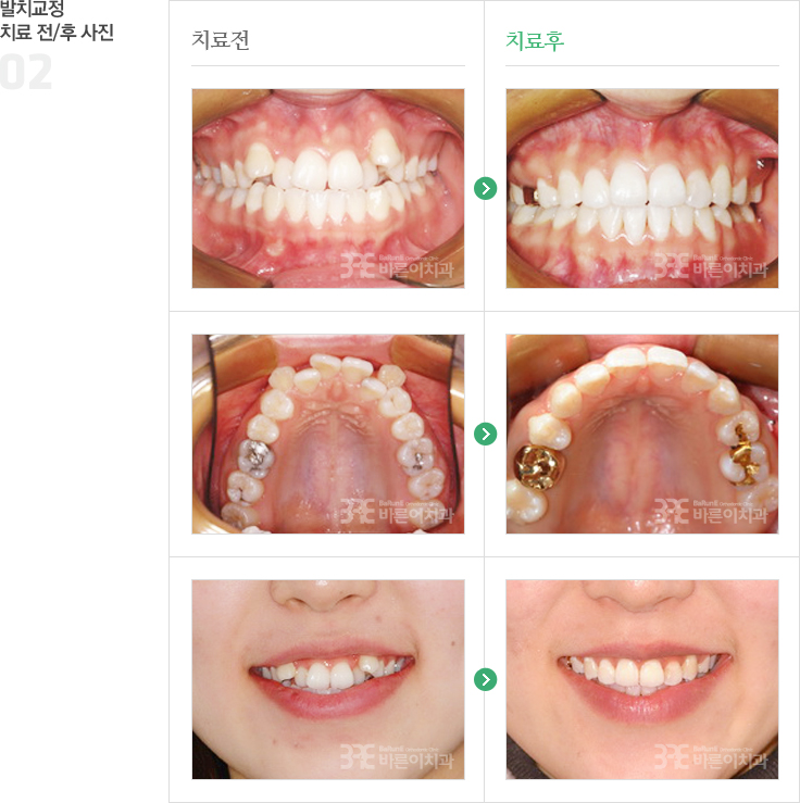 발치교정 치료 전/후 사진 이미지 02