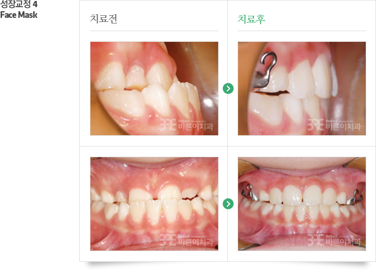 성장교정4/Face Mask