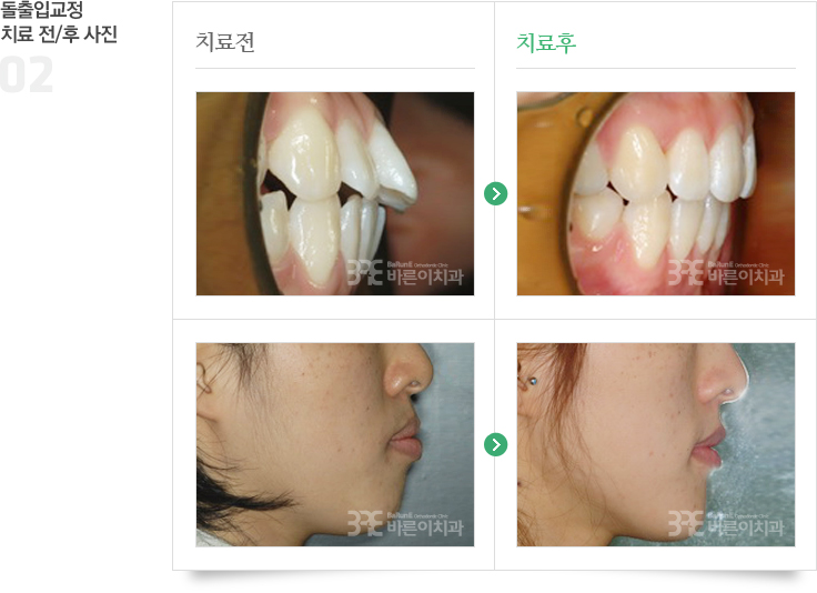 돌출입교정 치료 전/후 사진 이미지 02