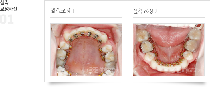 설측교정 치료 사진 이미지 01/02