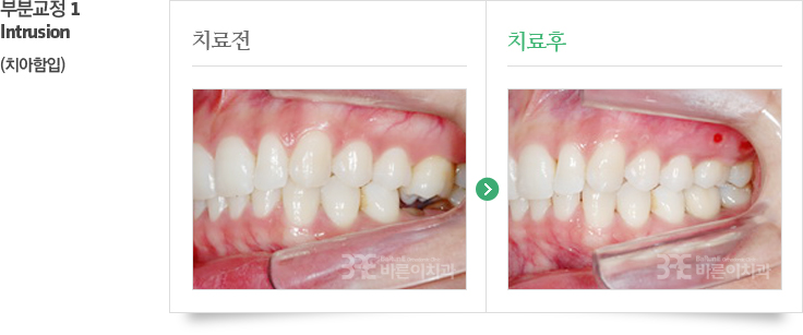 비발치교정 치료 전/후 사진 이미지 01