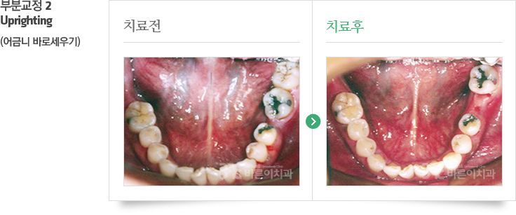 비발치교정 치료 전/후 사진 이미지 02