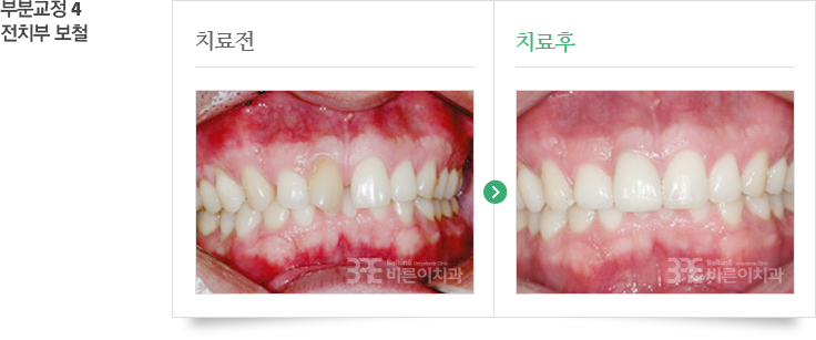 비발치교정 치료 전/후 사진 이미지 02