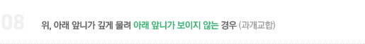 8. 위, 아래 앞니가 깊게 물려 아래 앞니가 보이지 않는 경우 (과개교합)