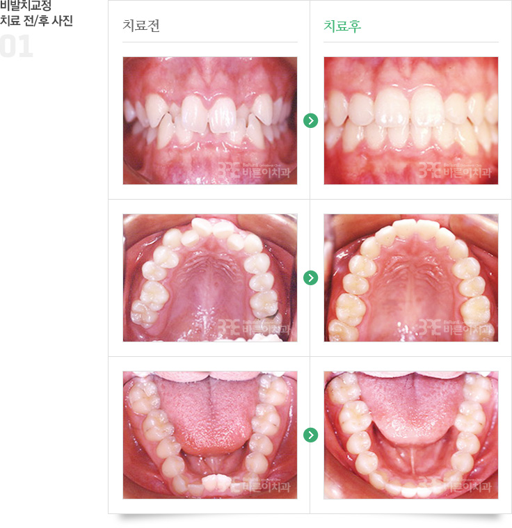 비발치교정 치료 전/후 사진 이미지 01