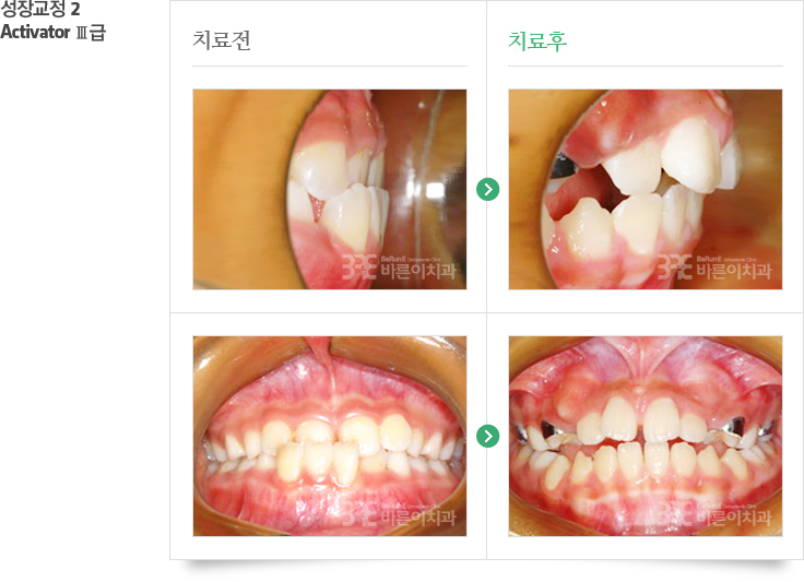 성장교정2/Activator Ⅲ급