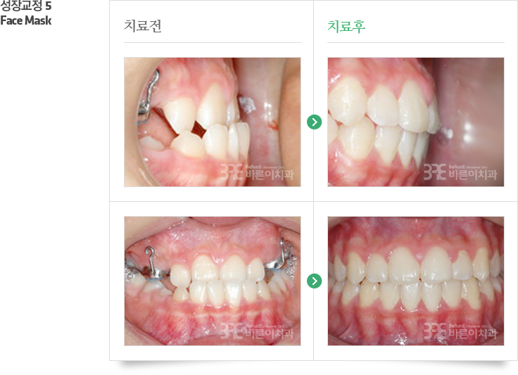 성장교정5/Face Mask