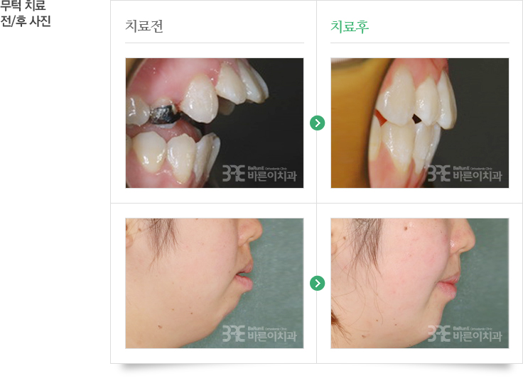 주걱턱 치료 전/후 사진 이미지 02