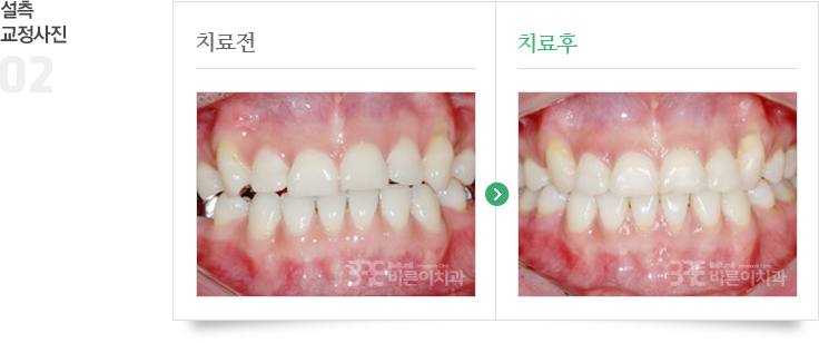 설측교정 치료 전/후 사진 이미지 01