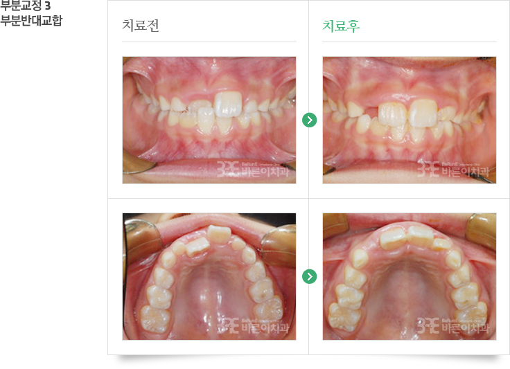 비발치교정 치료 전/후 사진 이미지 02